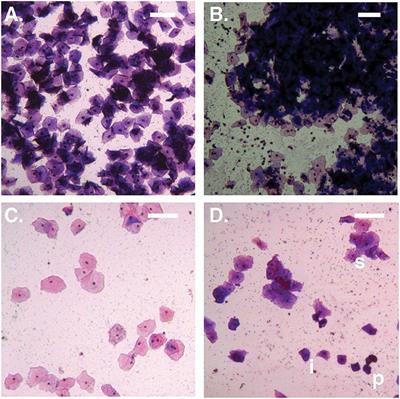 Asymptomatic Bacterial Vaginosis Is Associated With Depletion of Mature Superficial Cells Shed From the Vaginal Epithelium